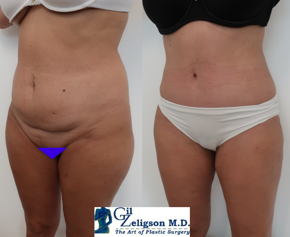 Dr. Gil Zeligson - Tummy Tuck Abdomino plasty
