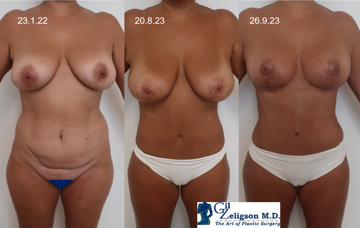 Dr. Gil Zeligson - Tummy Tuck Abdomino plasty