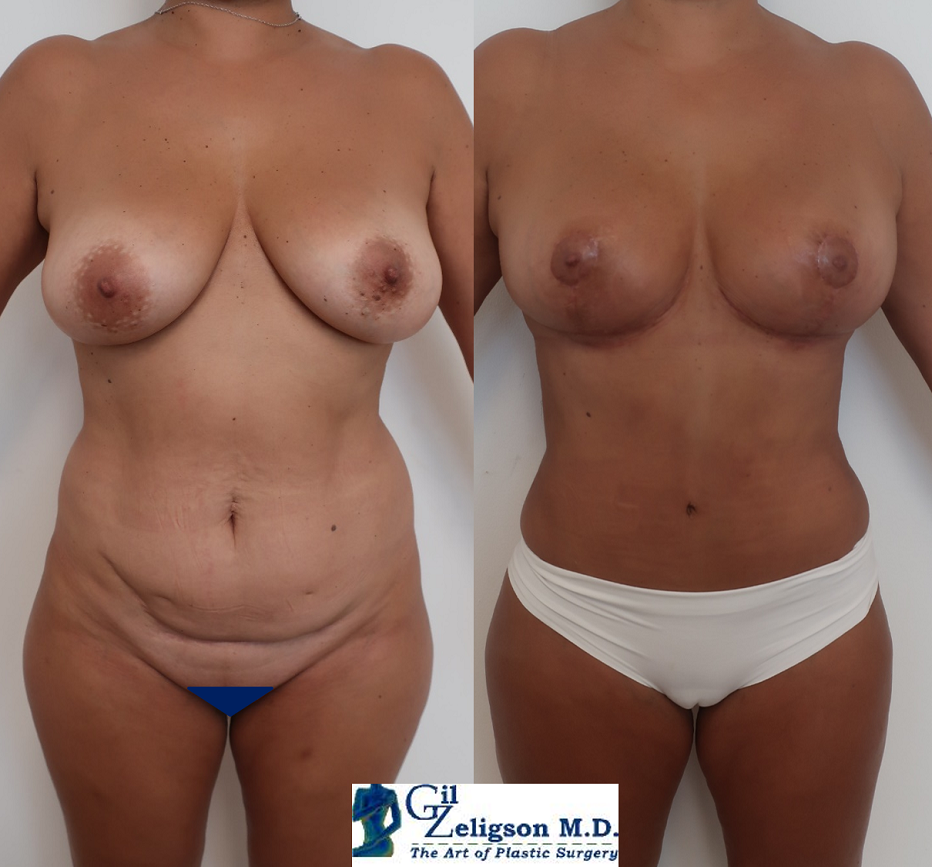 Dr. Gil Zeligson - Breast Reduction