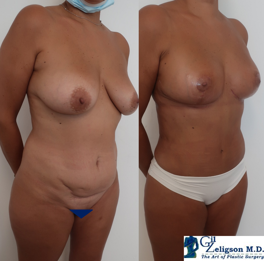 Dr. Gil Zeligson - Breast Reduction