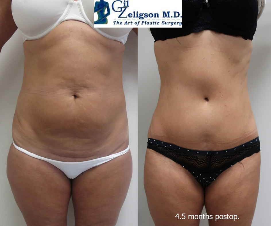 Dr. Gil Zeligson - Tummy Tuck Abdomino plasty