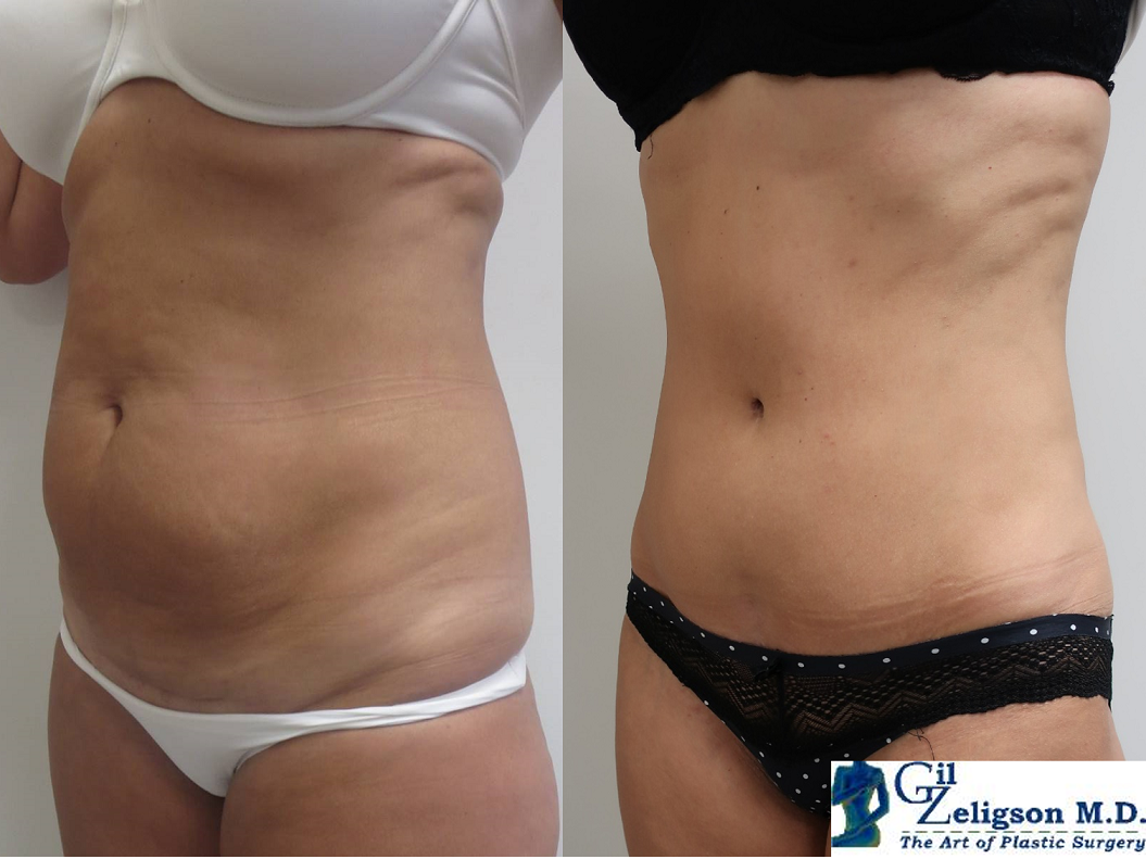 Dr. Gil Zeligson - Tummy Tuck Abdomino plasty