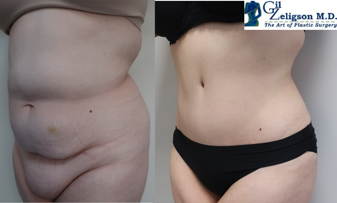Dr. Gil Zeligson - Tummy Tuck Abdomino plasty