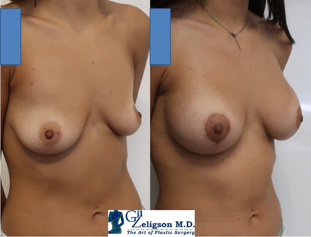 Dr. Gil Zeligson - Breast Asymmetry Correction