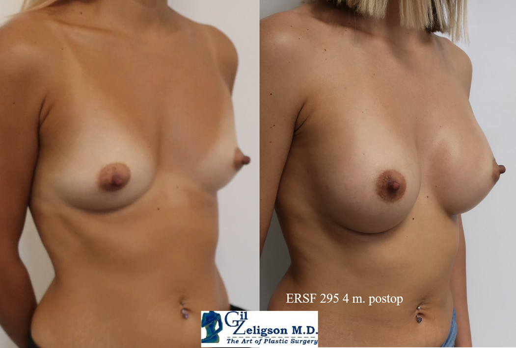 Dr. Gil Zeligson - Breast augmentation
