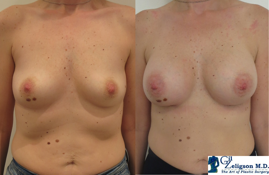 Dr. Gil Zeligson - Breast augmentation