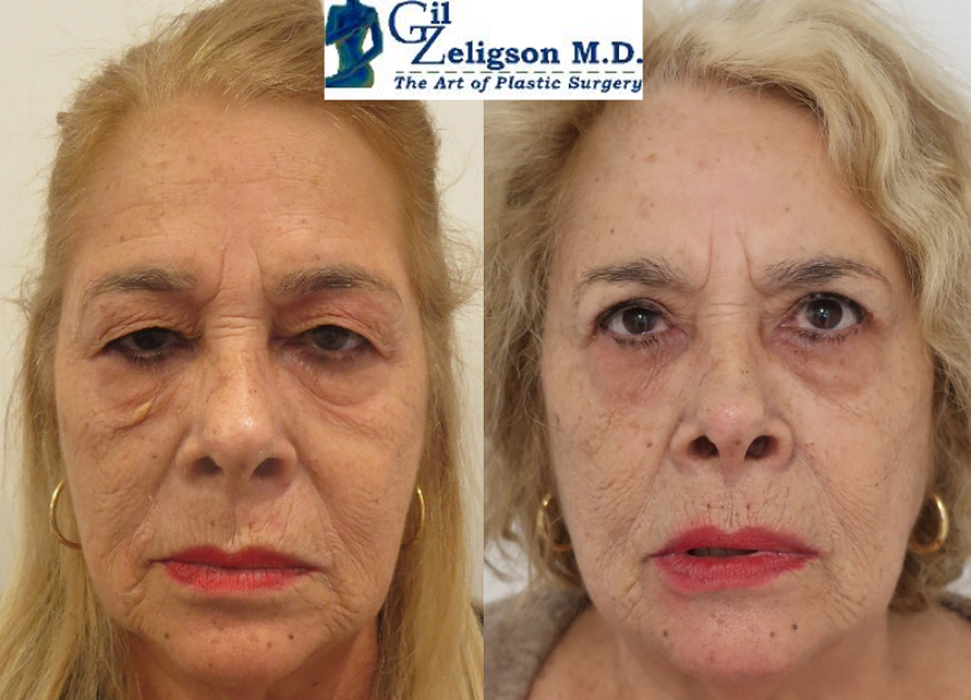 Dr. Gil Zeligson - Upper and Lower Eyelids