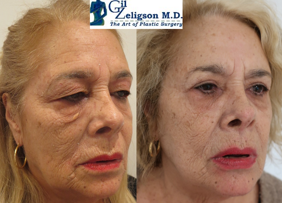 Dr. Gil Zeligson - Upper and Lower Eyelids