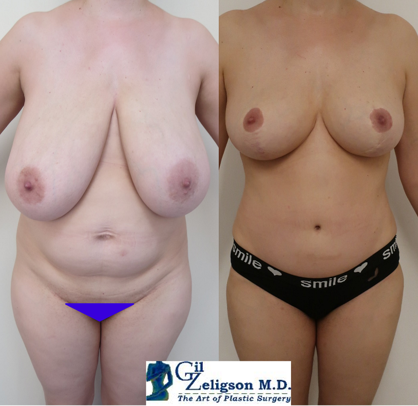 Dr. Gil Zeligson - Breast Reduction