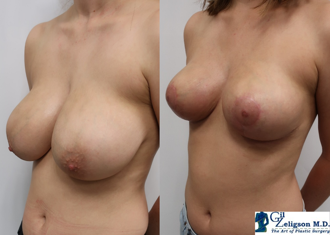 Dr. Gil Zeligson - Breast Reduction