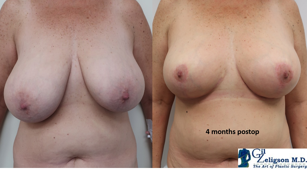 Dr. Gil Zeligson - Breast Reduction