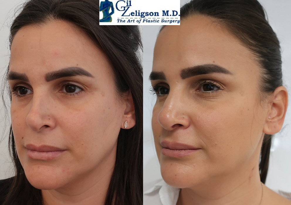 Dr. Gil Zeligson - Facial Sculpturing Hyaluronic acid