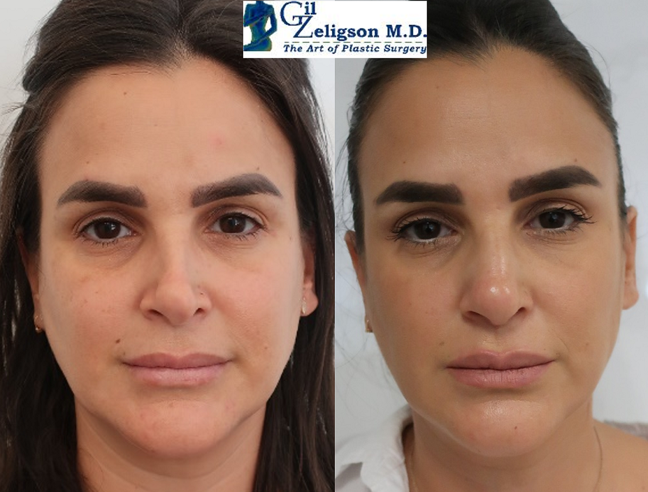 Dr. Gil Zeligson - Facial Sculpturing Hyaluronic acid
