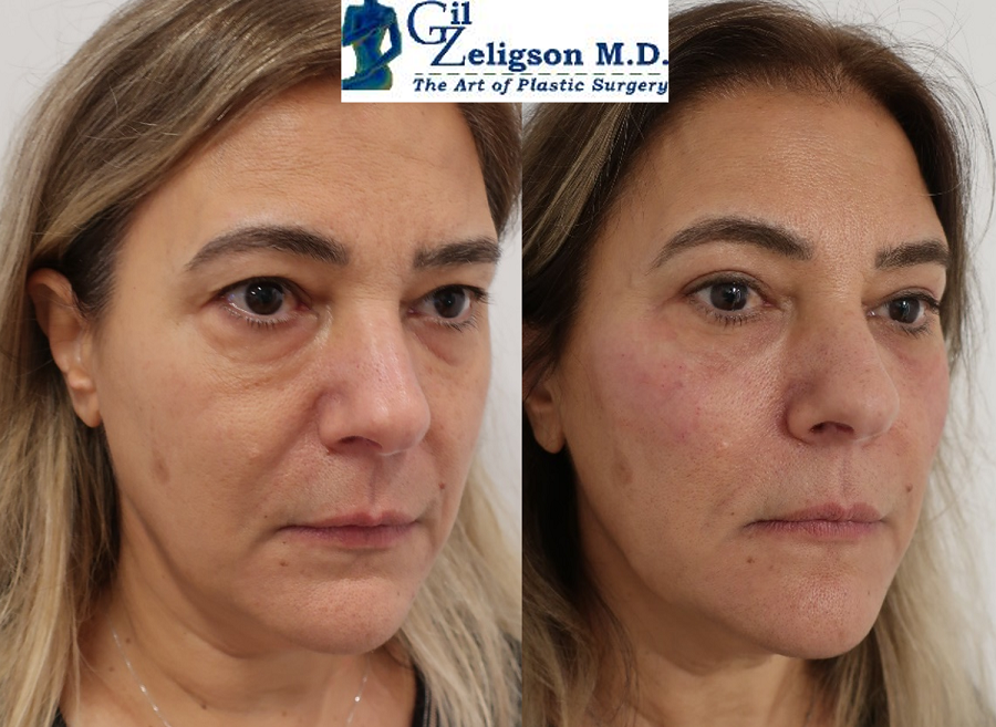Dr. Gil Zeligson - Facial Sculpturing Hyaluronic acid