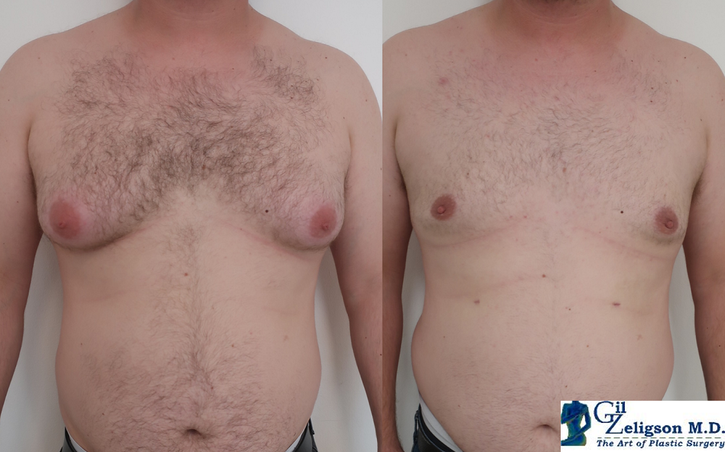 Dr. Gil Zeligson - Gynecomasty