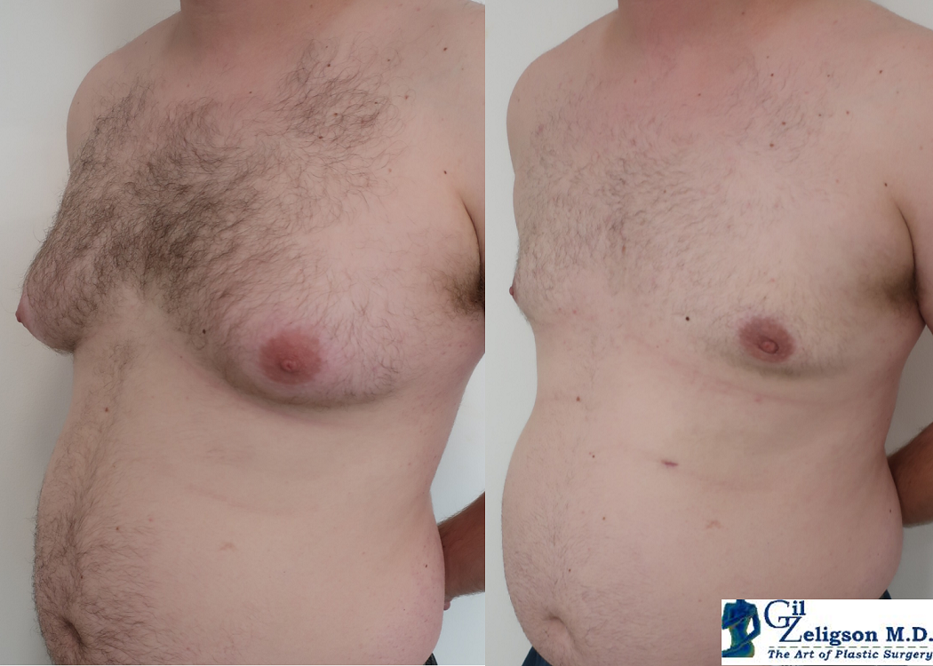Dr. Gil Zeligson - Gynecomasty