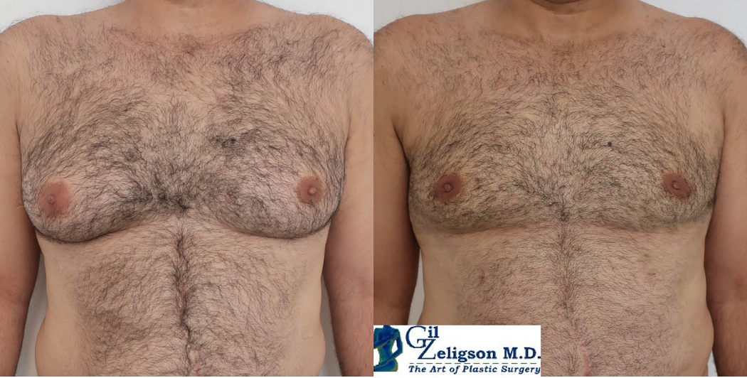 Dr. Gil Zeligson - Gynecomasty