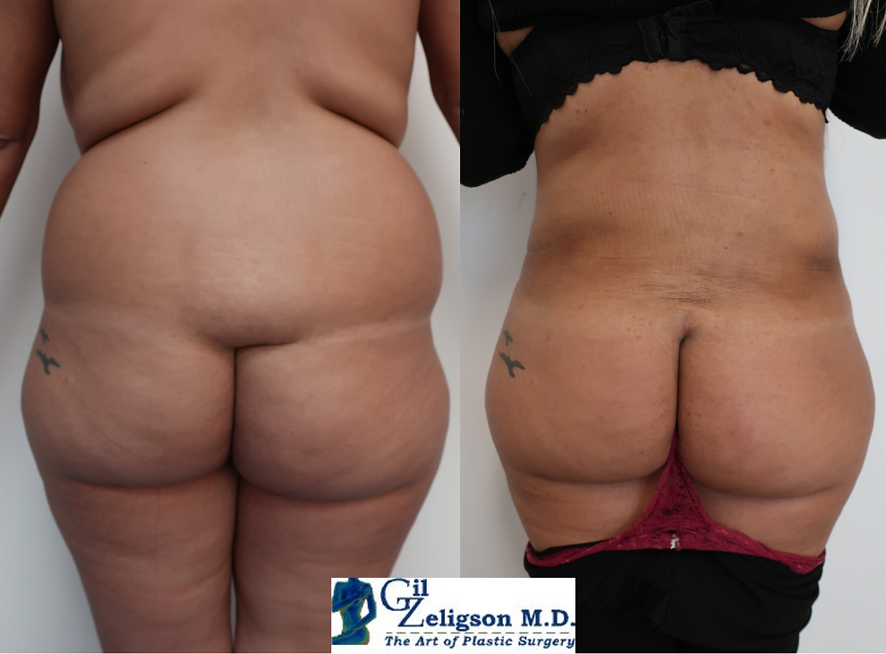 Dr. Gil Zeligson - Liposuction