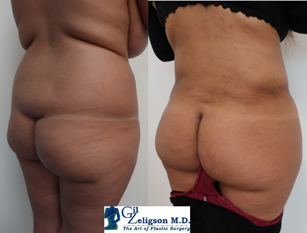 Dr. Gil Zeligson - Liposuction