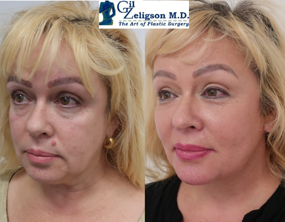 Dr. Gil Zeligson - Facelift