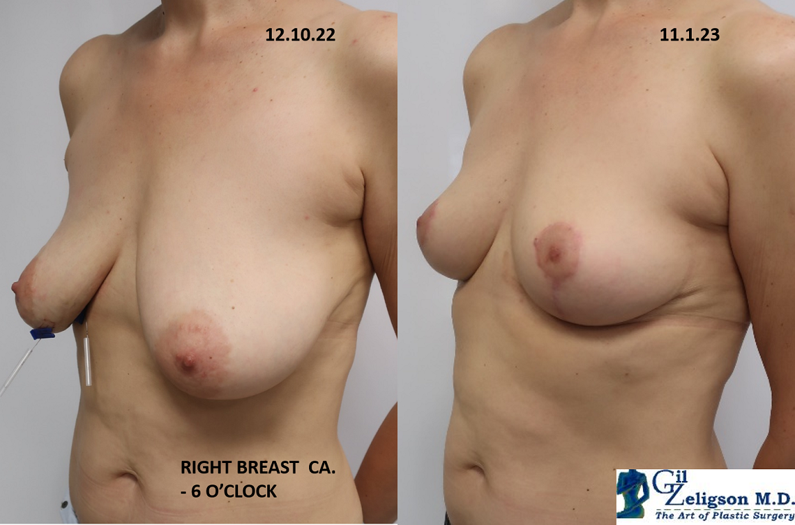 Dr. Gil Zeligson - Breast Reduction