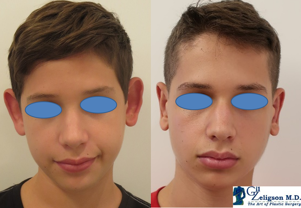 Dr. Gil Zeligson - Otoplasty