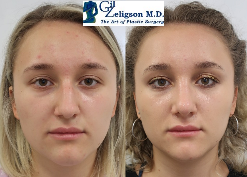 Dr. Gil Zeligson - Rhinoplasty