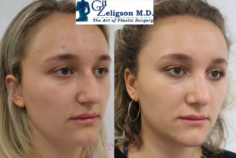 Dr. Gil Zeligson - Rhinoplasty