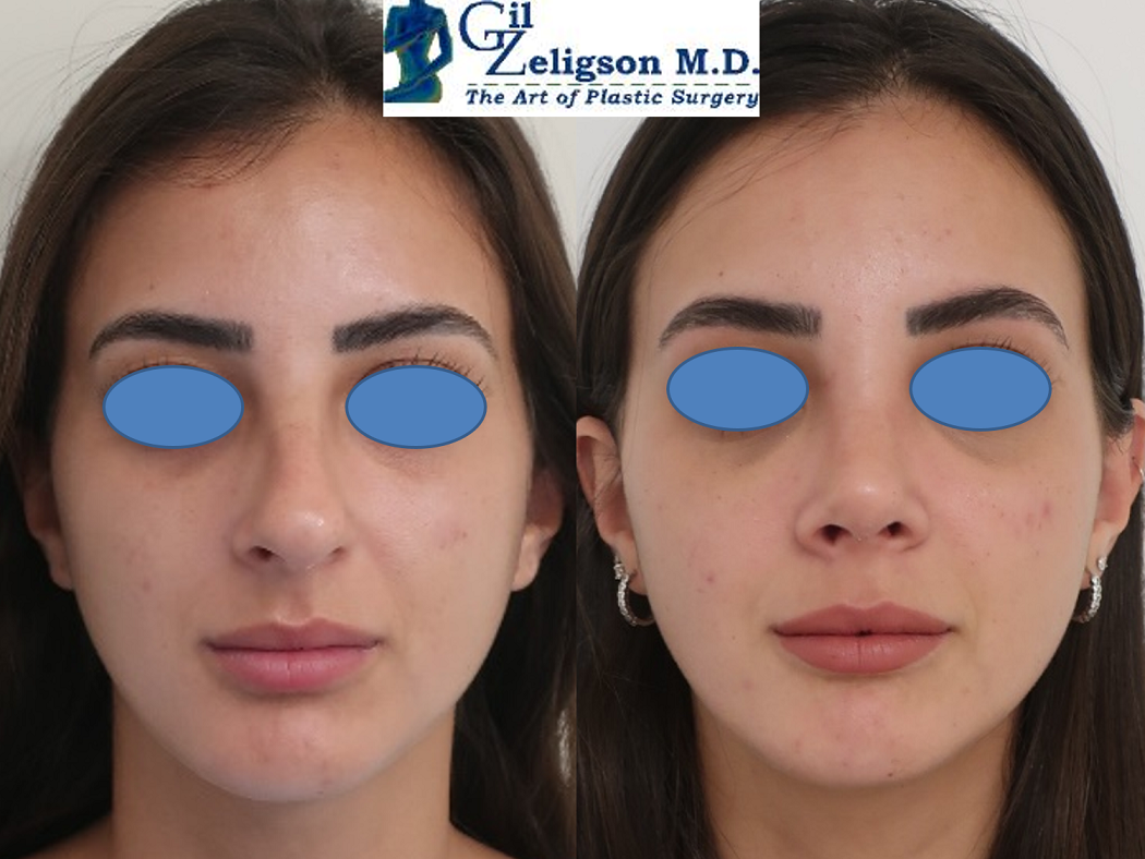 Dr. Gil Zeligson - Rhinoplasty