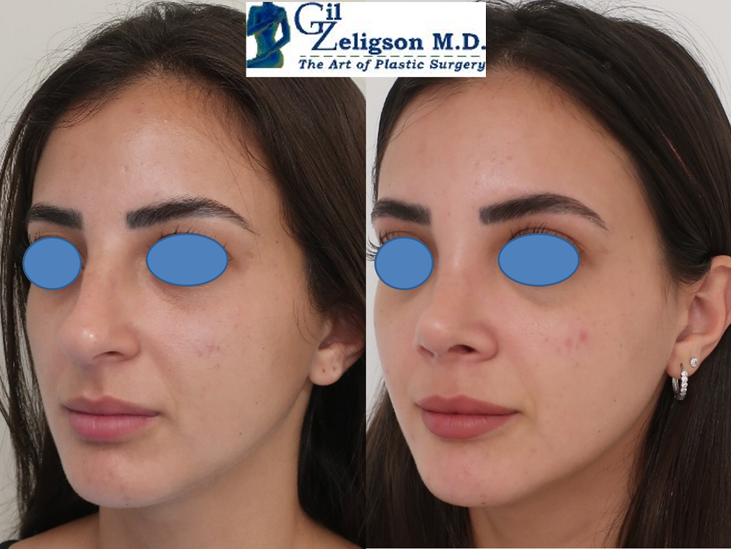 Dr. Gil Zeligson - Rhinoplasty