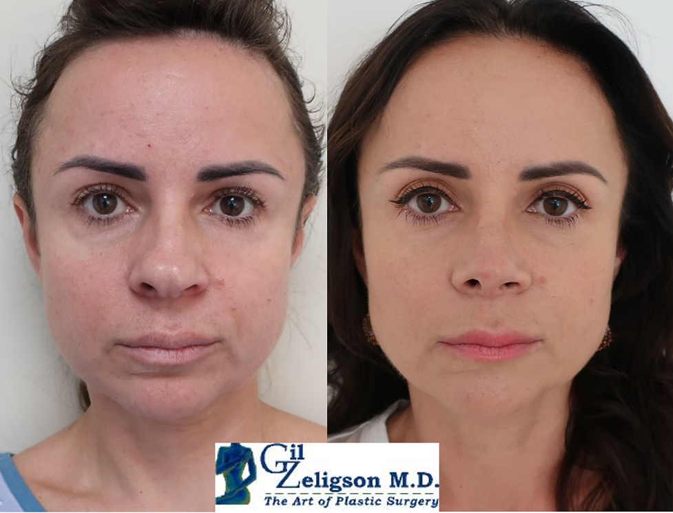 Dr. Gil Zeligson - Facial Sculpturing Hyaluronic acid