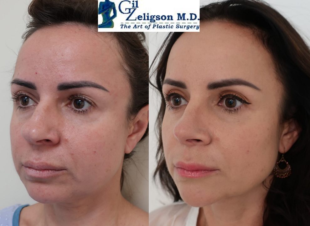 Dr. Gil Zeligson - Rhinoplasty