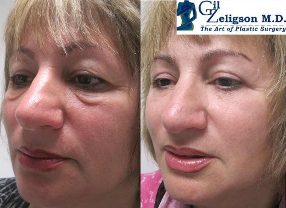 Dr. Gil Zeligson - Upper and Lower Eyelids