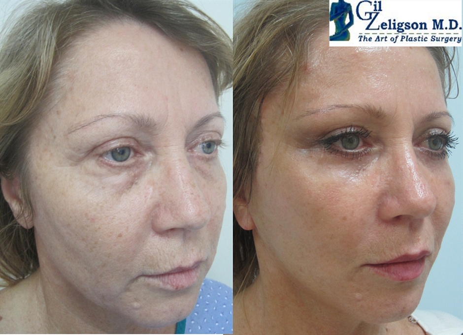 Dr. Gil Zeligson - Facelift