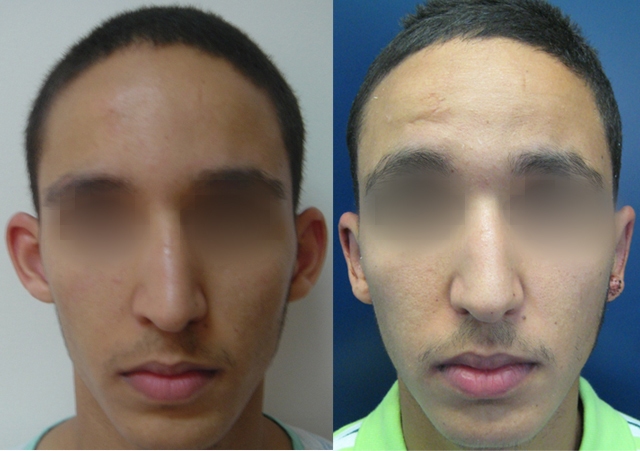 Dr. Gil Zeligson - Otoplasty