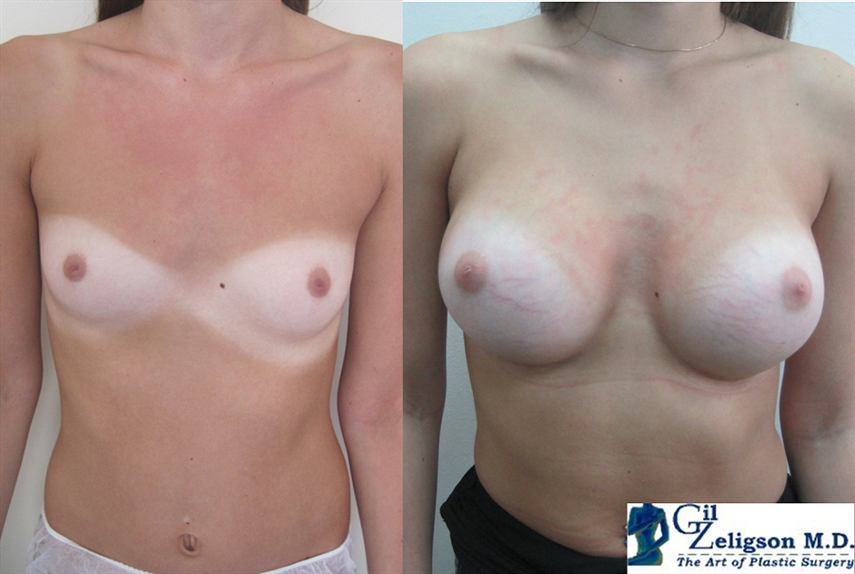 Dr. Gil Zeligson - Breast augmentation
