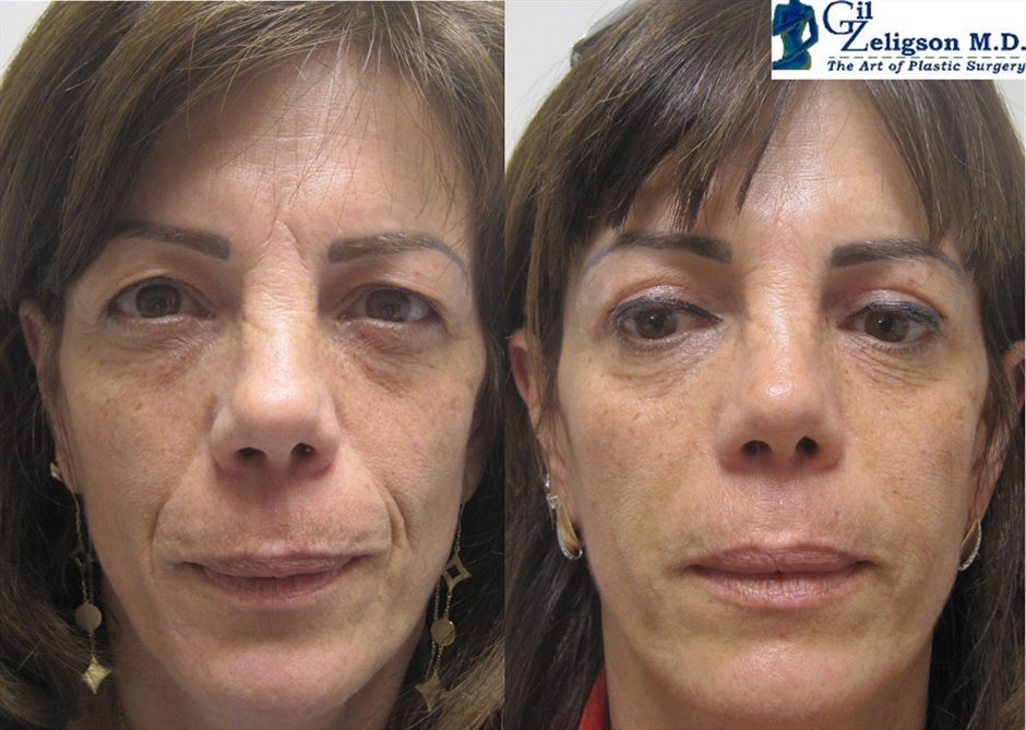 Dr. Gil Zeligson - Upper and Lower Eyelids