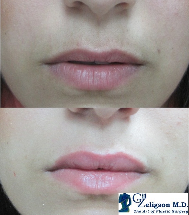 Dr. Gil Zeligson - Lips augmentaion & Wrinkles filling
