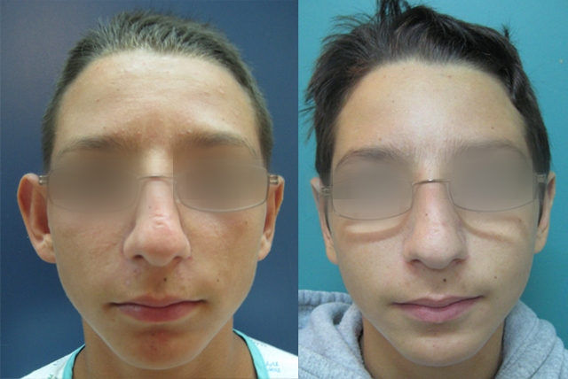 Dr. Gil Zeligson - Otoplasty