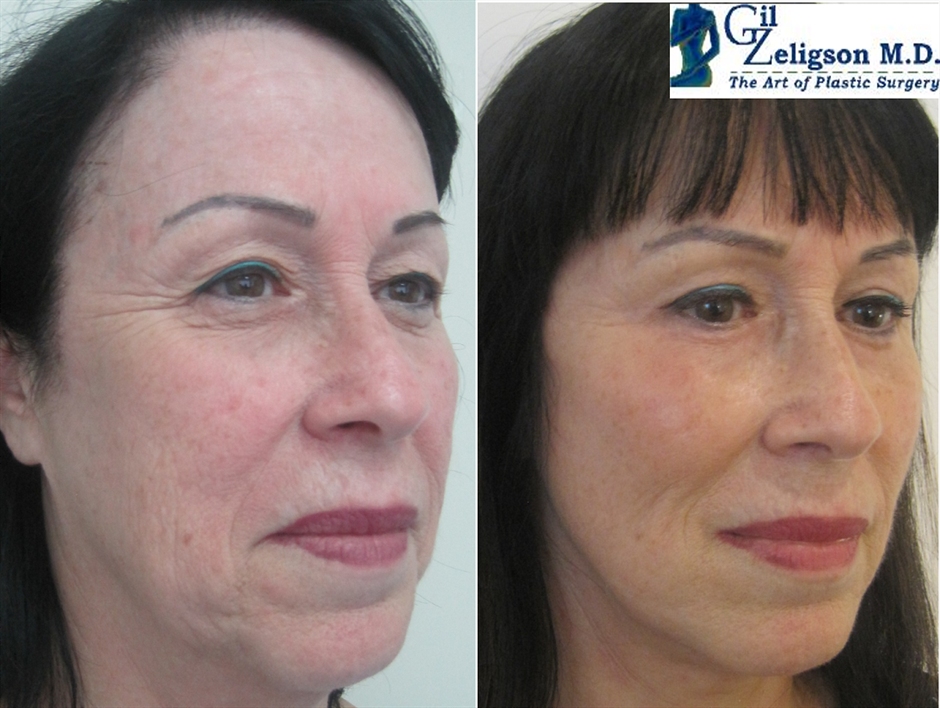 Dr. Gil Zeligson - Facelift