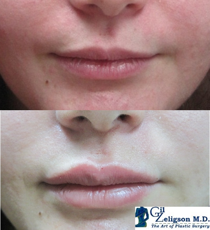Dr. Gil Zeligson - Lips augmentaion & Wrinkles filling