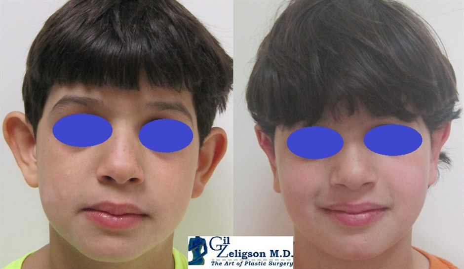 Dr. Gil Zeligson - Otoplasty