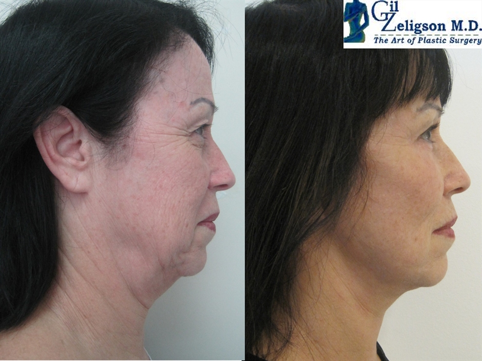 Dr. Gil Zeligson - Facelift