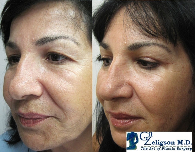 Dr. Gil Zeligson - Upper and Lower Eyelids