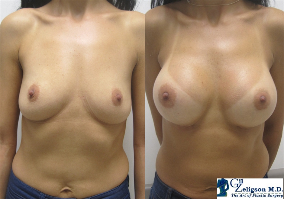 Dr. Gil Zeligson - Breast augmentation