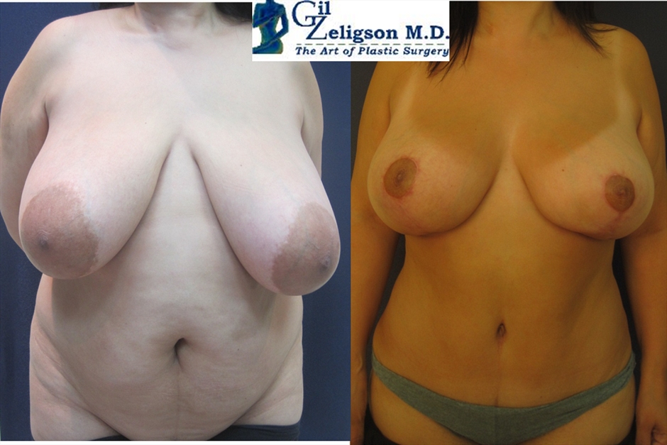 Dr. Gil Zeligson - Breast Reduction
