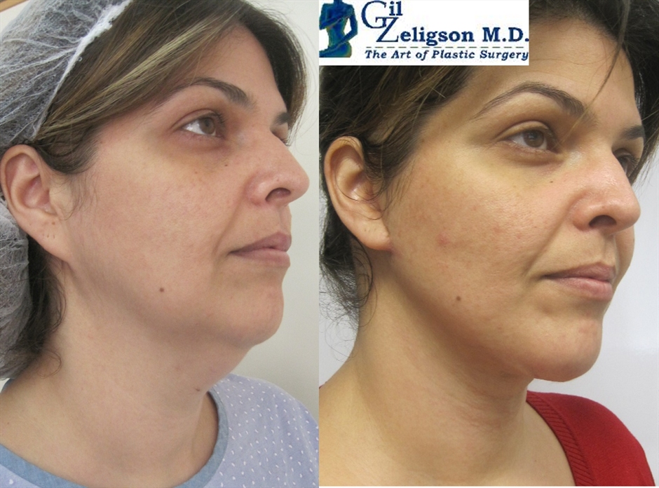 Dr. Gil Zeligson - Facelift