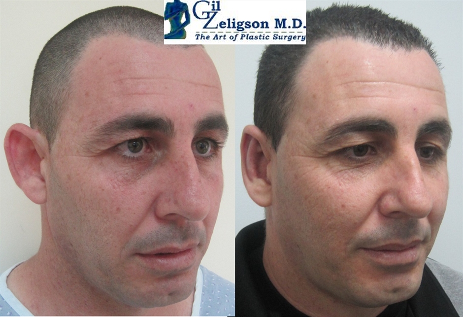 Dr. Gil Zeligson - Otoplasty