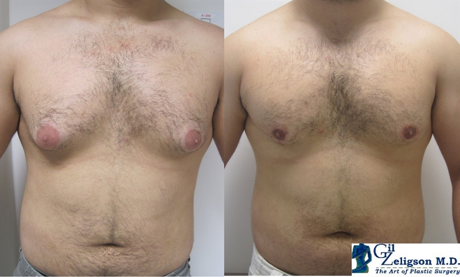 Dr. Gil Zeligson - Gynecomasty
