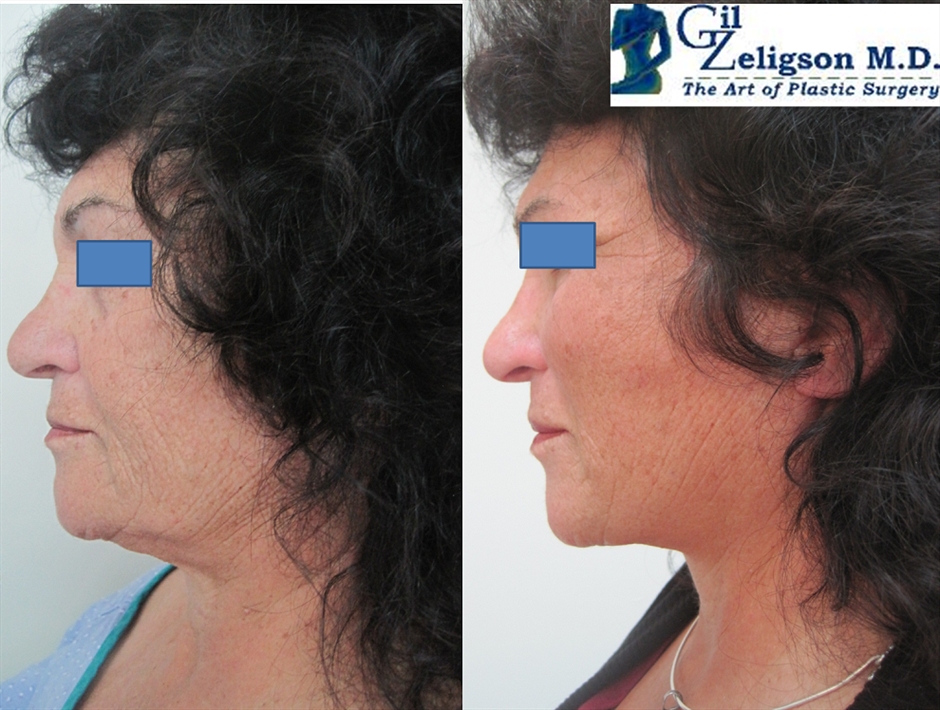 Dr. Gil Zeligson - Facelift
